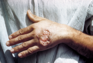 Leishmaniasis