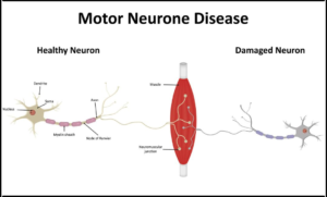 Motor Neuron Disease