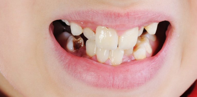 what-causes-tooth-decay