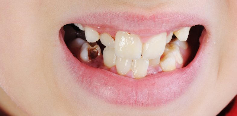 what-causes-tooth-decay