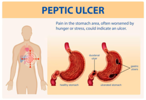 Ulcers