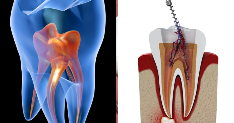 Vital Dental Pulp