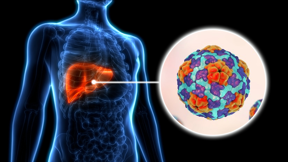 Hepatitis