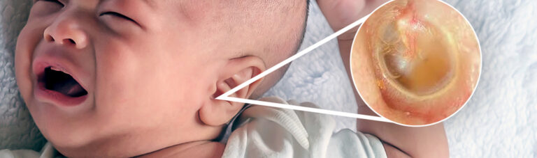 Ear Infections in Children