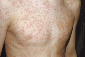 Rubella symptoms