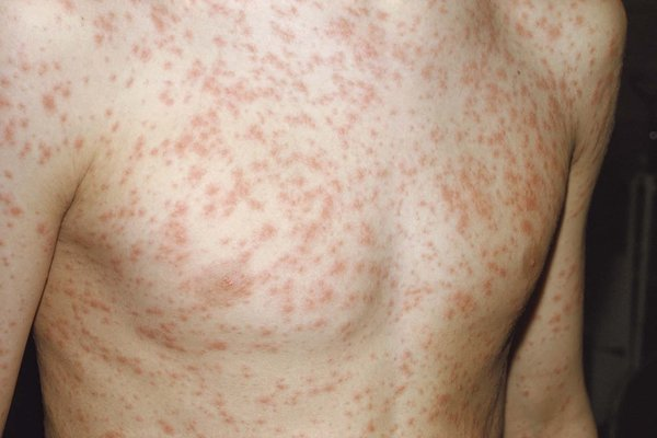 Rubella symptoms