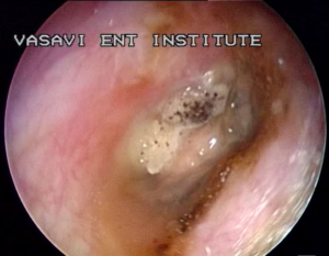 Fungal Ear Infections