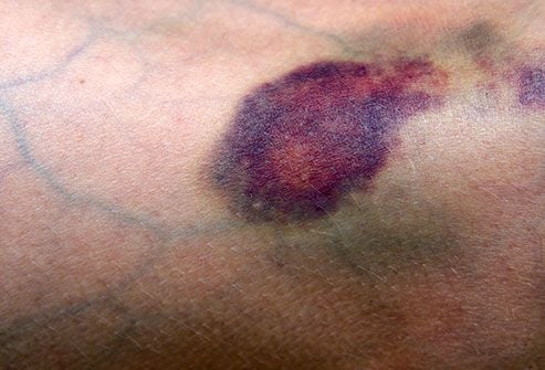 Hematoma