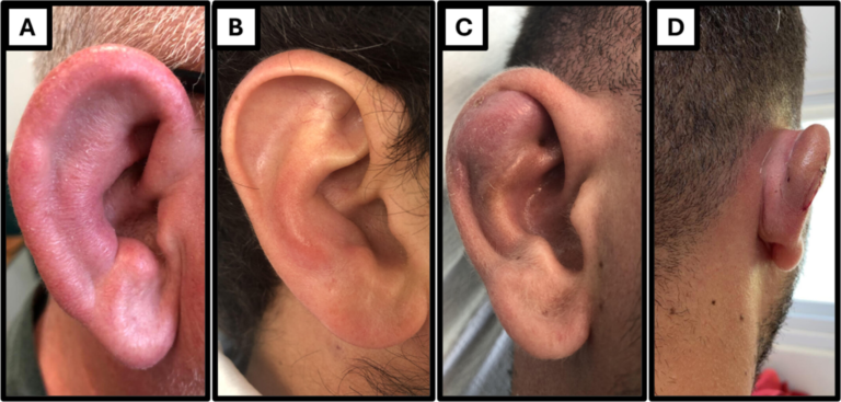 Perichondritis