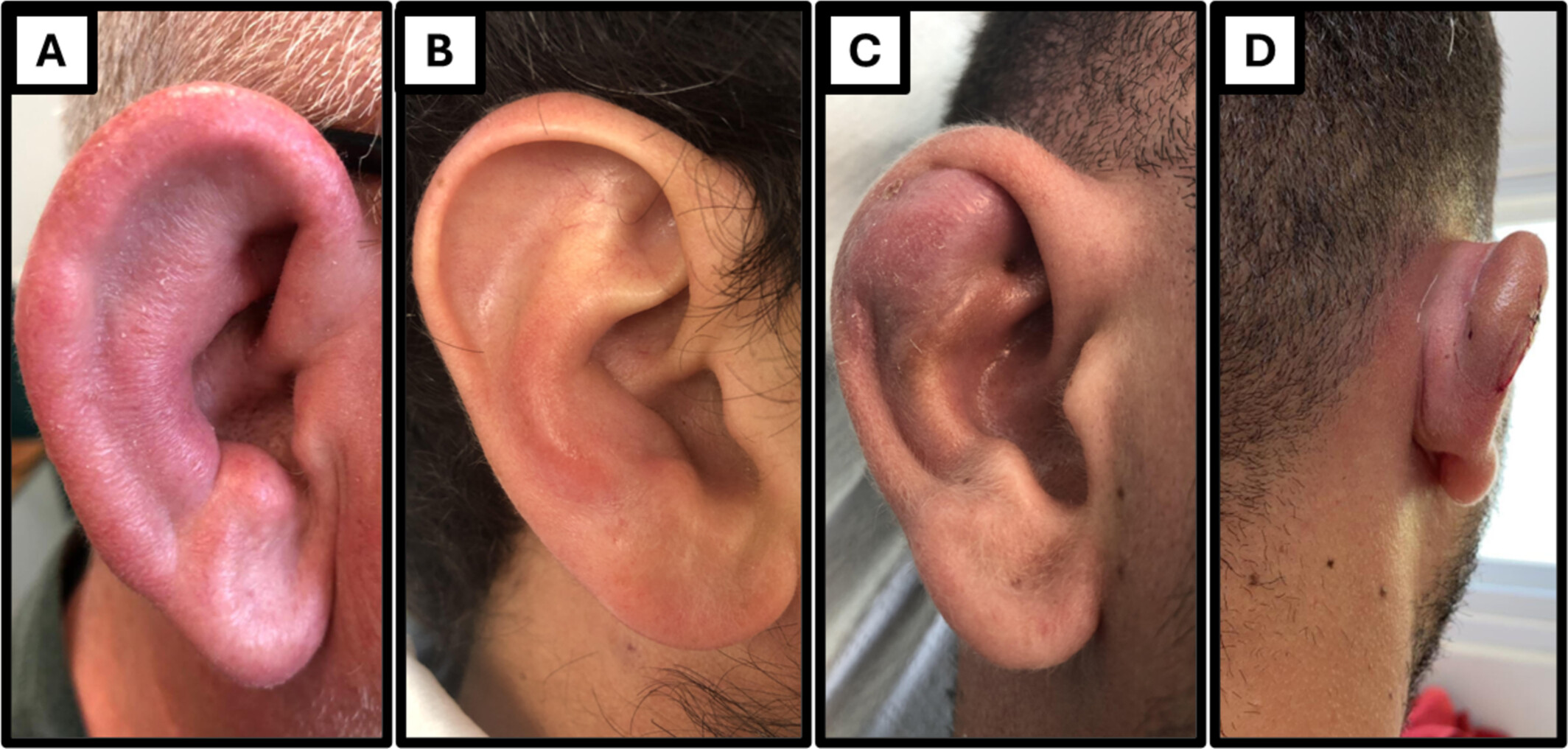 Perichondritis