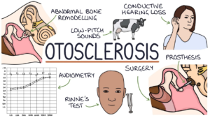 Otosclerosis