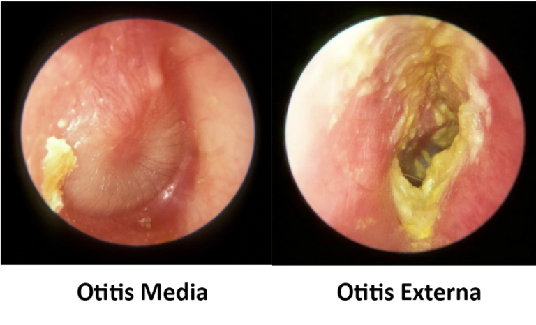 Otitis Media