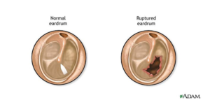 Perforated Eardrum