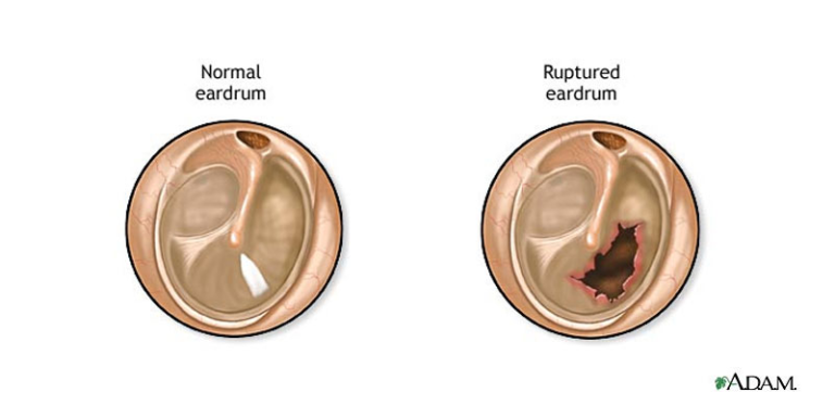 Perforated Eardrum