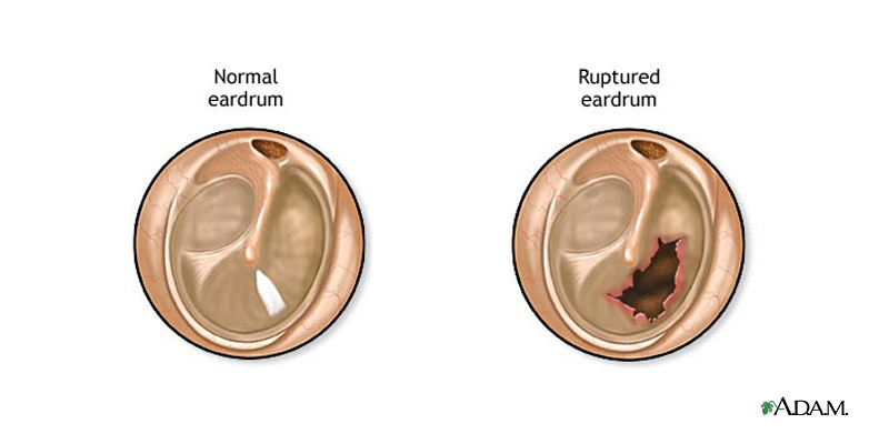 Perforated Eardrum
