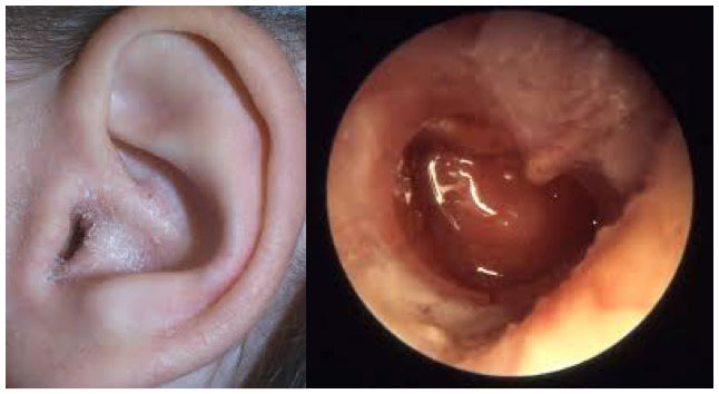 Otitis Externa (Swimmer's Ear)