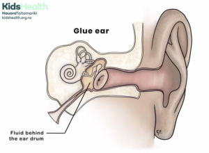 Glue Ear