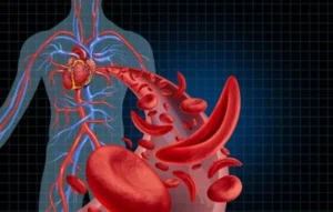 Sickle cell disease