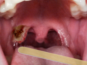 Tonsil Cancer