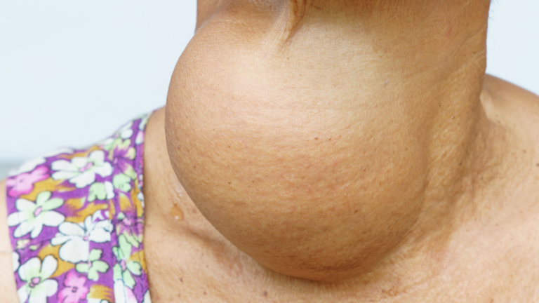 Goiter