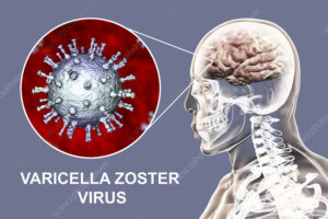 Varicella Zoster Encephalitis and Vasculopathy